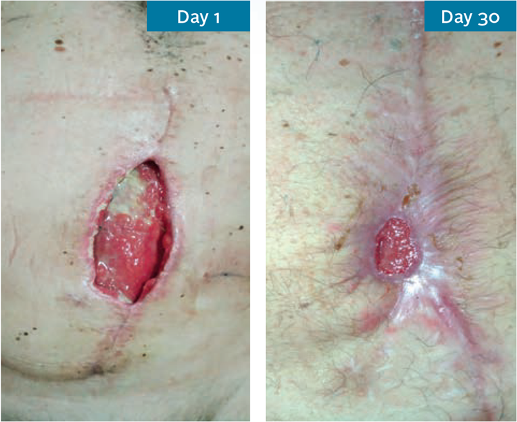 Dehisced Abdominal Wound Image - Avelle Study